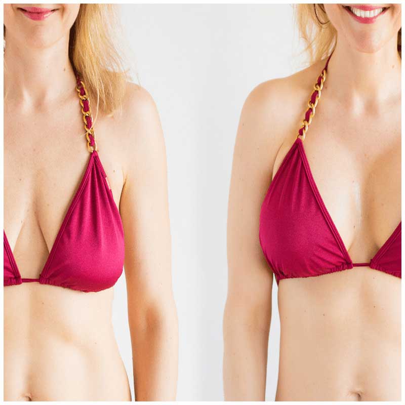 Breast-Augmentation