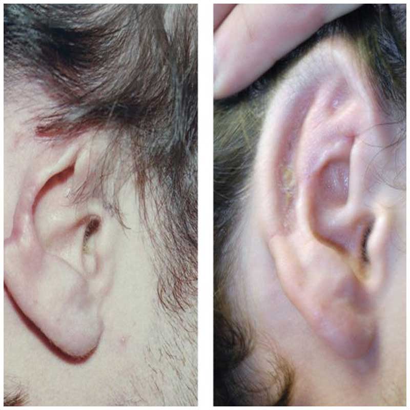 Ear-Reconstruction