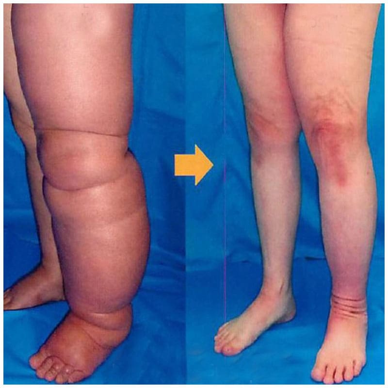 Lymphedema-Surgery