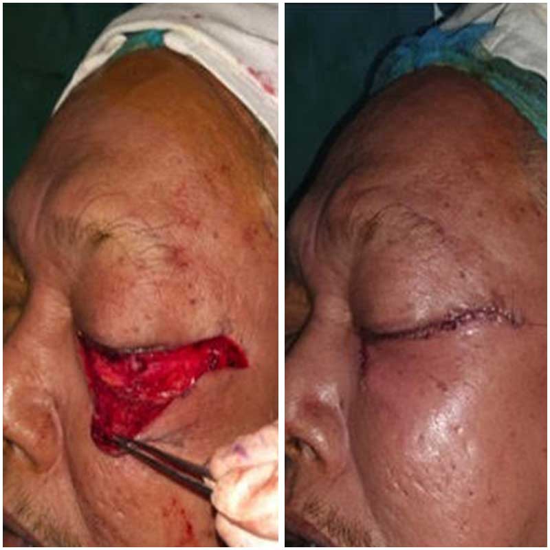 eyelid-reconstruction